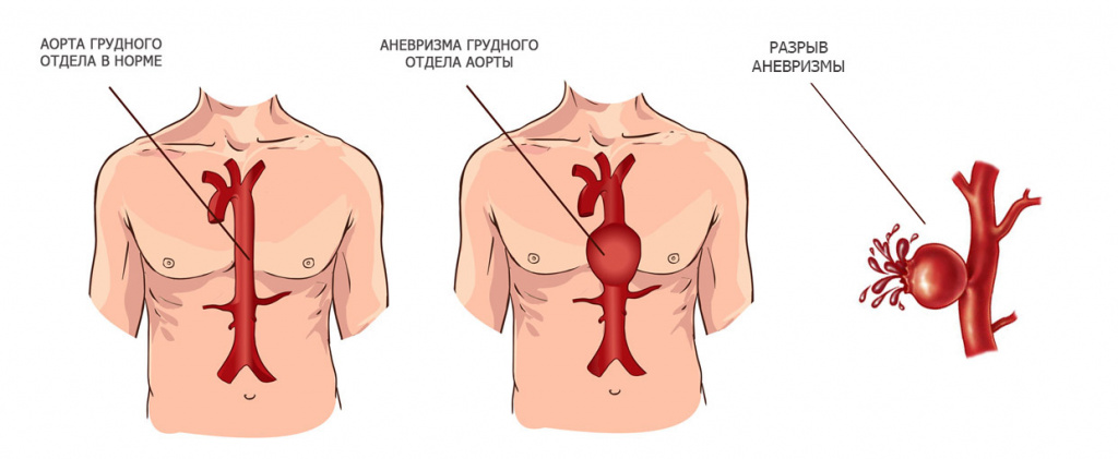 КТ грудной аорты - показания при аневризме